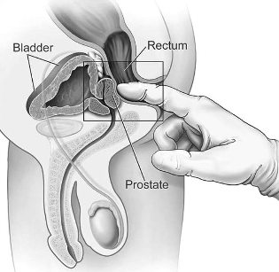treatment of prostate in house massage